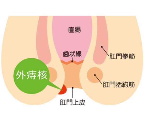 いぼ痔