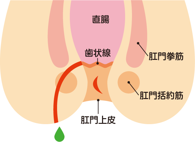 あな痔（痔ろう）